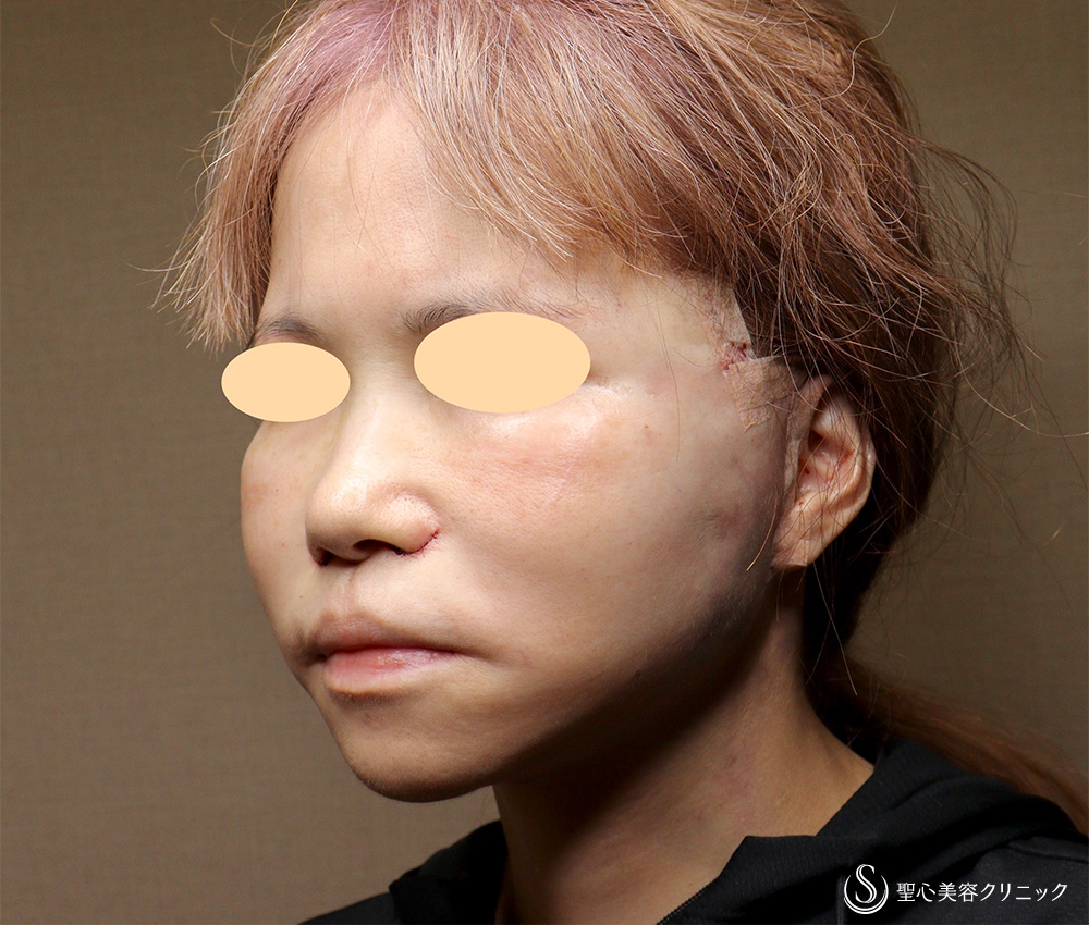 【50代女性・顔の弛み】エクステンデッドディーププレーンフェイスリフト（術後直後～術後3ヶ月） After 