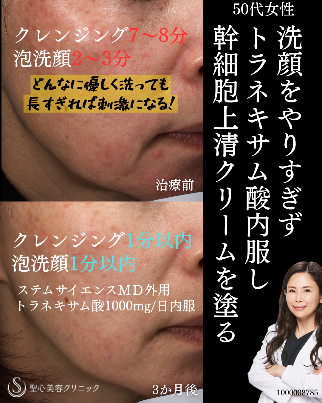 【50代女性・やりすぎないスキンケア】トラネキサム酸錠（トランサミン酸錠）＋ステムサイエンスM.D.（3ヶ月後） After 