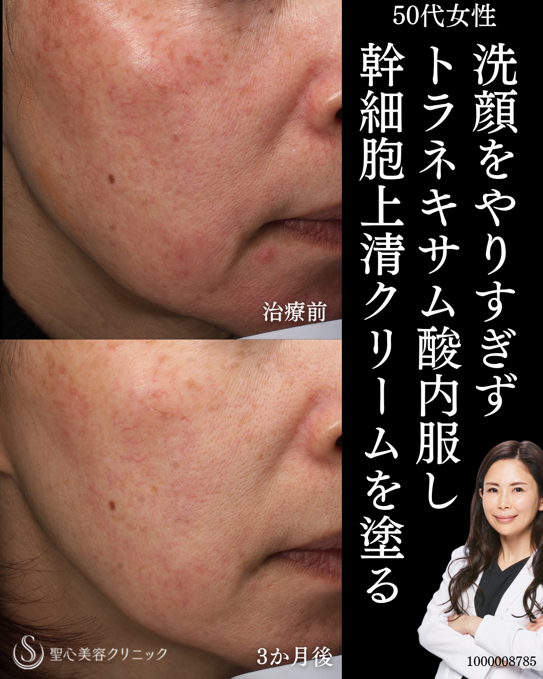 【50代女性・やりすぎないスキンケア】トラネキサム酸錠（トランサミン酸錠）＋ステムサイエンスM.D.（3ヶ月後） After 