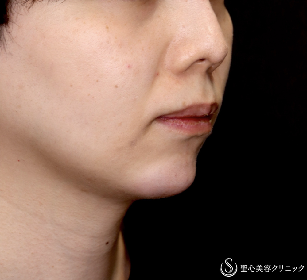 【30代男性・Eラインを整え、端正な顔立ちの印象へ】ヒアルロン酸注入（顎）（直後） After 