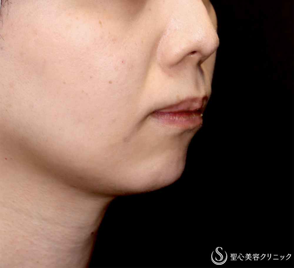 【30代男性・Eラインを整え、端正な顔立ちの印象へ】ヒアルロン酸注入（顎）（直後） Before 