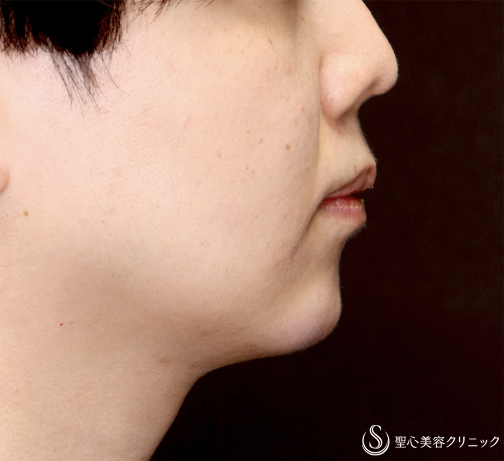 【30代男性・Eラインを整え、端正な顔立ちの印象へ】ヒアルロン酸注入（顎）（直後） After 