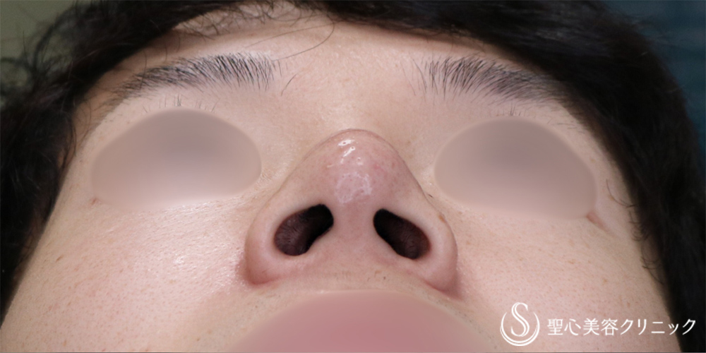 【20代男性・自然な忘れ鼻へ】鼻尖縮小＋小鼻縮小（1ヶ月後） Before 