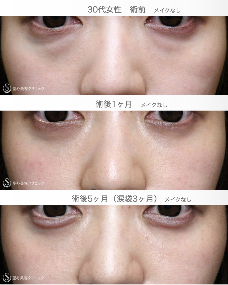 【30代女性・目の下のクマ】経結膜下脱脂術（5ヶ月後）→涙袋ヒアルロン酸（3ヶ月後） After 