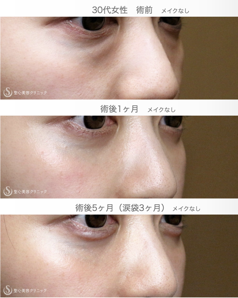 【30代女性・目の下のクマ】経結膜下脱脂術（5ヶ月後）→涙袋ヒアルロン酸（3ヶ月後） After 