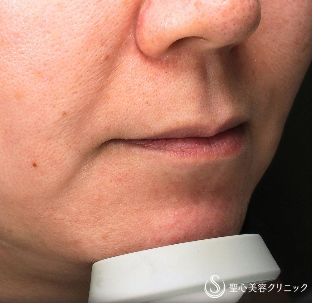 【40代女性・ハリのあるリップ】ヒアルロン酸注入（直後） Before 