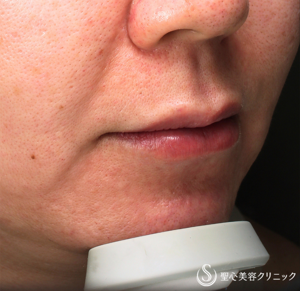 【40代女性・ハリのあるリップ】ヒアルロン酸注入（直後） After 