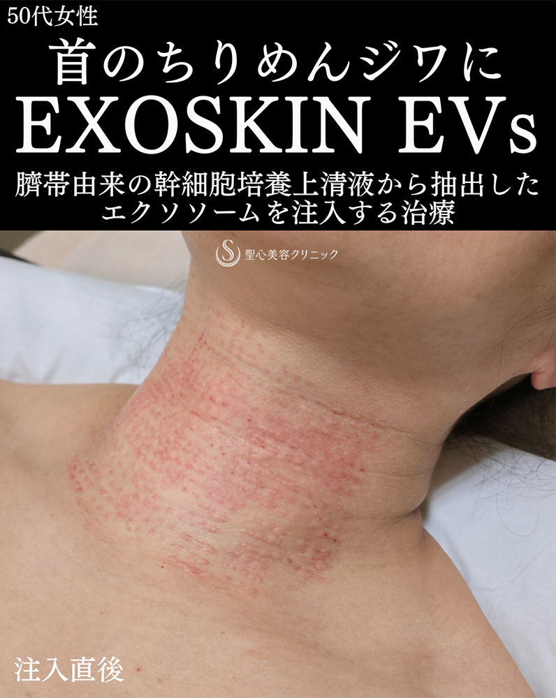 【50代女性・首のちりめんジワ】EXOSKIN EVs（エクソスキンイーヴィーズ）（直後～1ヶ月後） After 