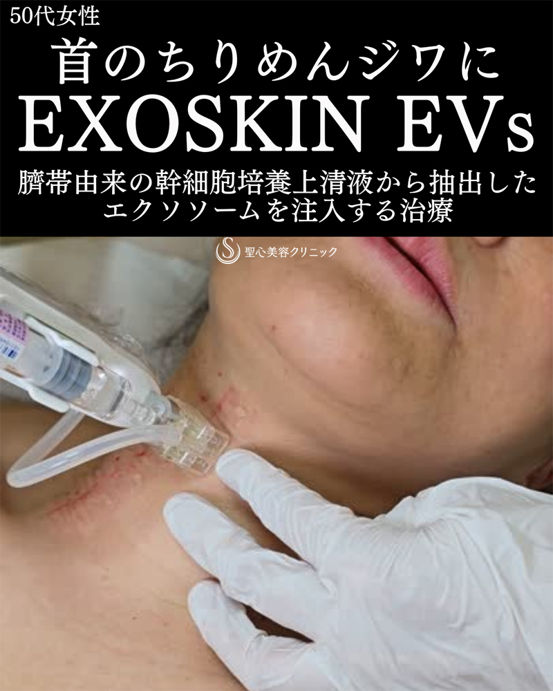 【50代女性・首のちりめんジワ】EXOSKIN EVs（エクソスキンイーヴィーズ）（直後～1ヶ月後） After 