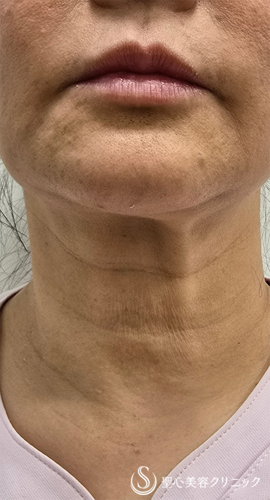 【50代女性・首のちりめんジワ】EXOSKIN EVs（エクソスキンイーヴィーズ）（直後～1ヶ月後） Before 