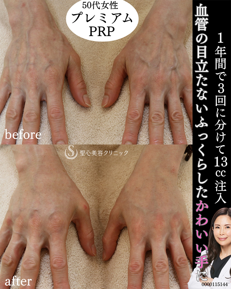 【50代女性・注入で血管の見えないハリのある手を】プレミアムPRP皮膚再生療法（1年後） After 
