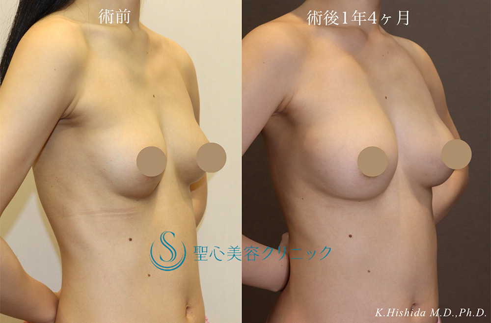 【20代女性・ナチュラルで美しいバストにしたい】ステムサップ豊胸術（StemSup™）（1年4ヶ月後） After 