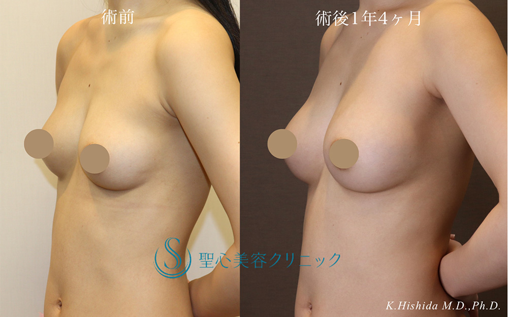 【20代女性・ナチュラルで美しいバストにしたい】ステムサップ豊胸術（StemSup™）（1年4ヶ月後） After 