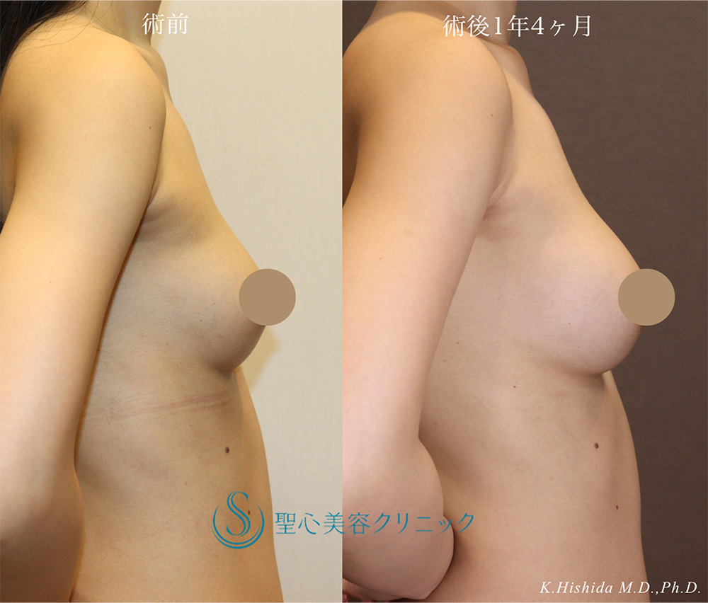 【20代女性・ナチュラルで美しいバストにしたい】ステムサップ豊胸術（StemSup™）（1年4ヶ月後） After 