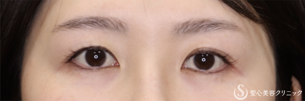 【30代女性・左右差のない末広二重】マイクロメソッド+α（二重埋没法）（1ヶ月後） Before 