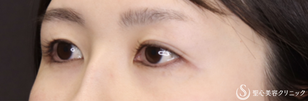 【30代女性・左右差のない末広二重】マイクロメソッド+α（二重埋没法）（1ヶ月後） Before 