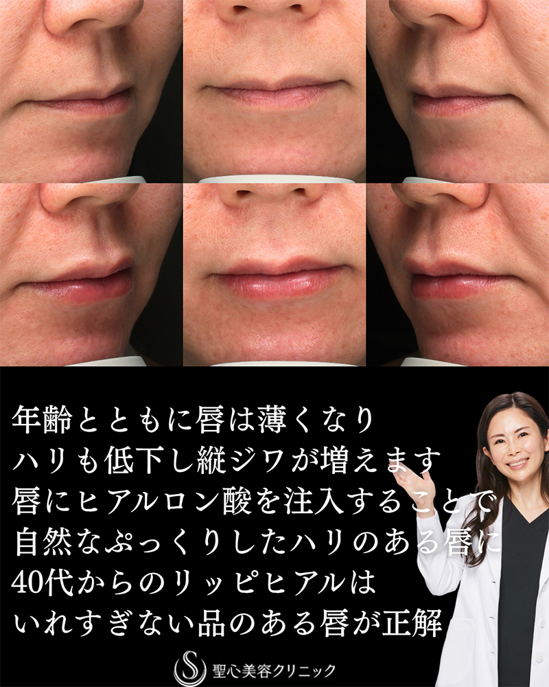 【40代女性・ハリのあるリップ】ヒアルロン酸注入（直後） After 