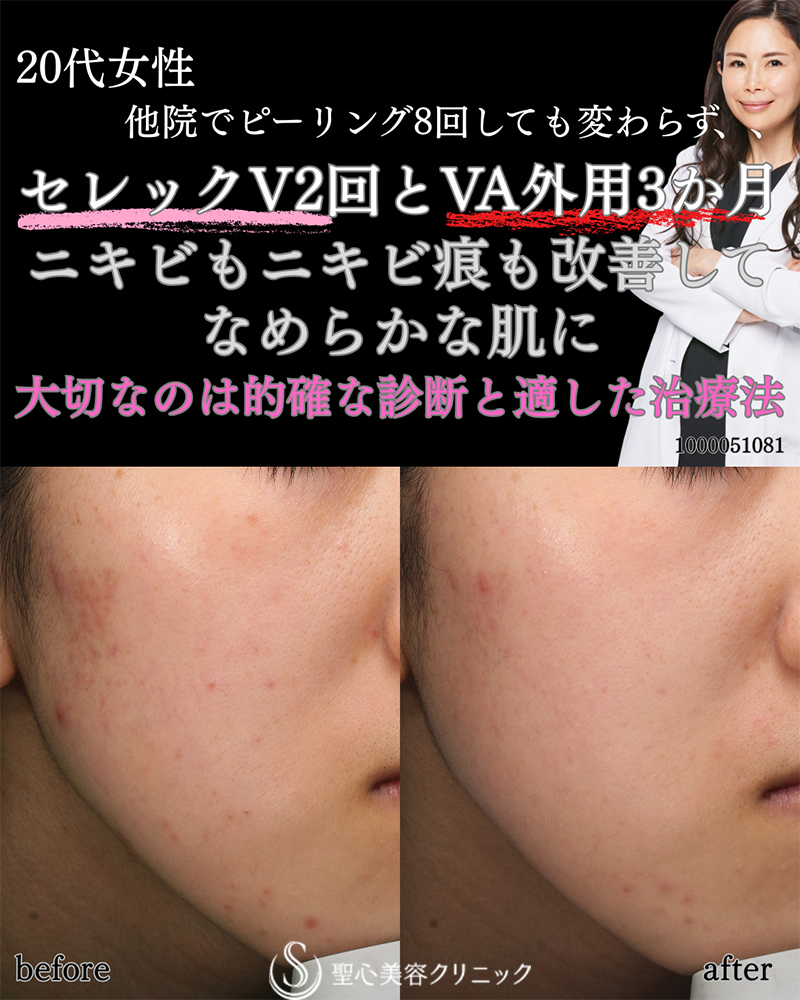 【20代女性・ニキビ痕を改善させなめらかな肌に】ナノメッド VA エッセンス外用＋CellecV（セレックV）（3ヶ月後、2回照射後） After 