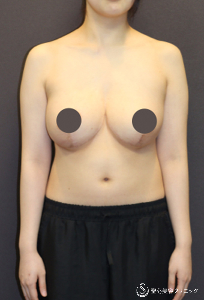 【20代女性・バストを小さくしたい】乳房縮小術（Pitanguy法）（6ヶ月後） After 