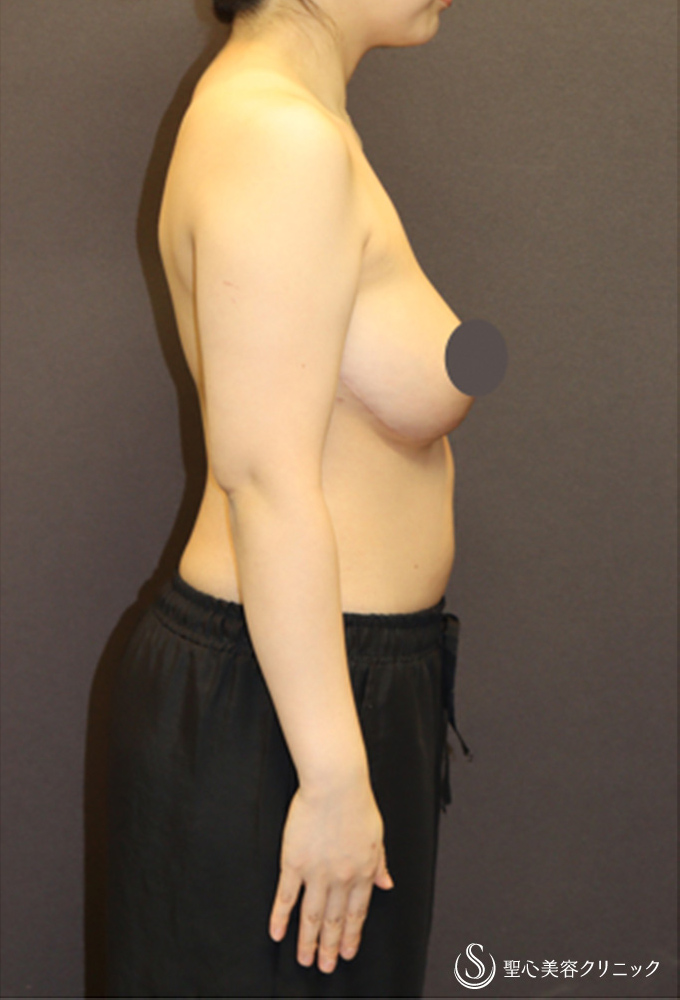 【20代女性・バストを小さくしたい】乳房縮小術（Pitanguy法）（6ヶ月後） After 