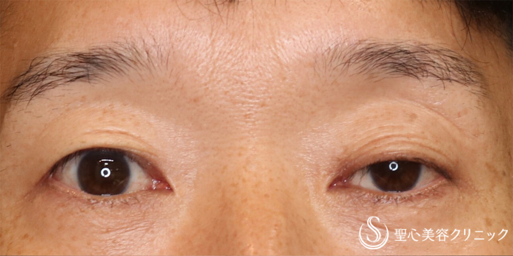 【50代男性・目の開きの左右差を改善】眼瞼下垂（片目/埋没法）（直後） Before 