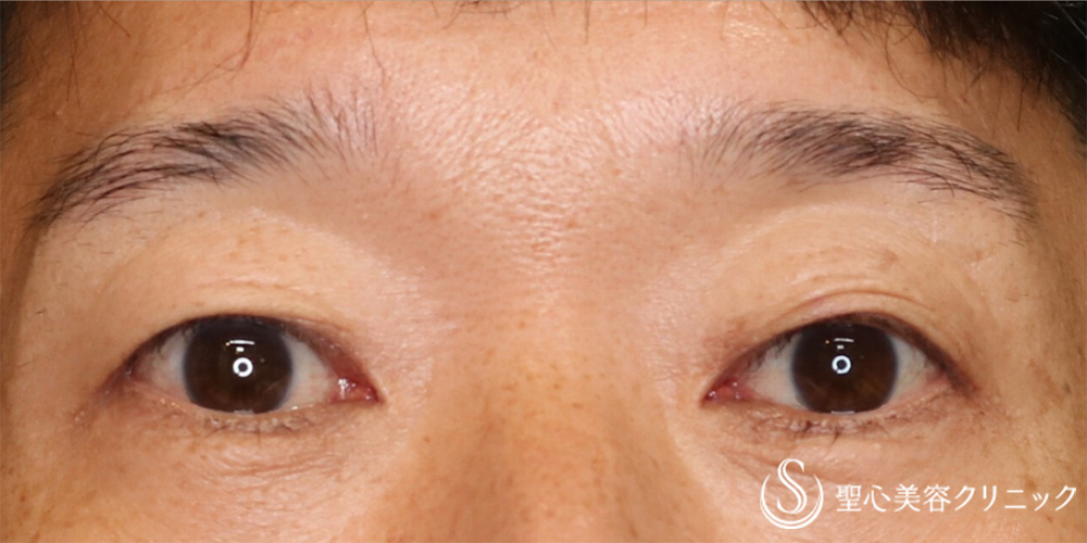 【50代男性・目の開きの左右差を改善】眼瞼下垂（片目/埋没法）（直後） After 