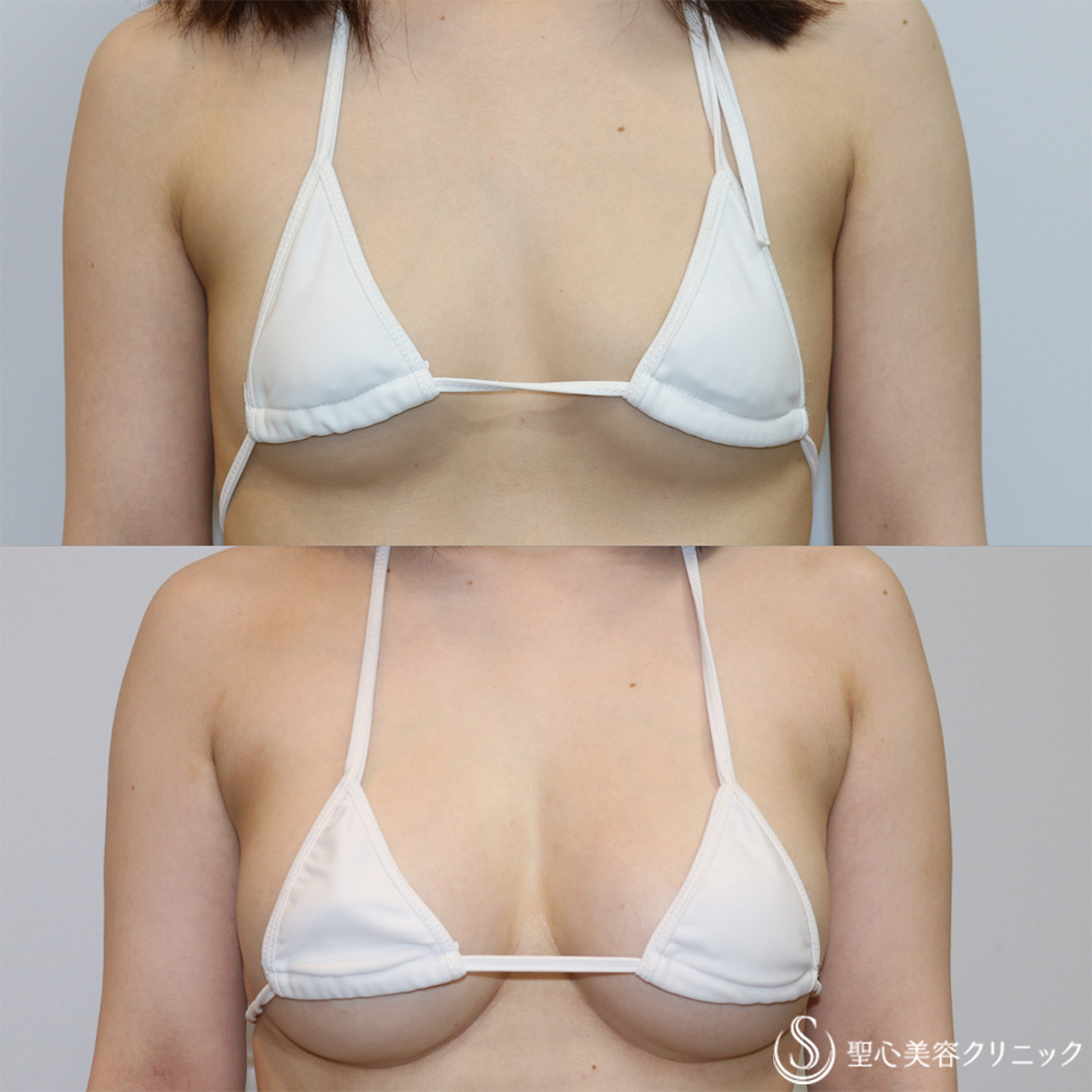 【30代女性・理想のシルエットへボリュームアップ】ハイブリット豊胸術（ピュアグラフト/モティバ230cc）（1年6ヶ月後） After #ハイブリット豊胸　#豊胸　#バストアップ
