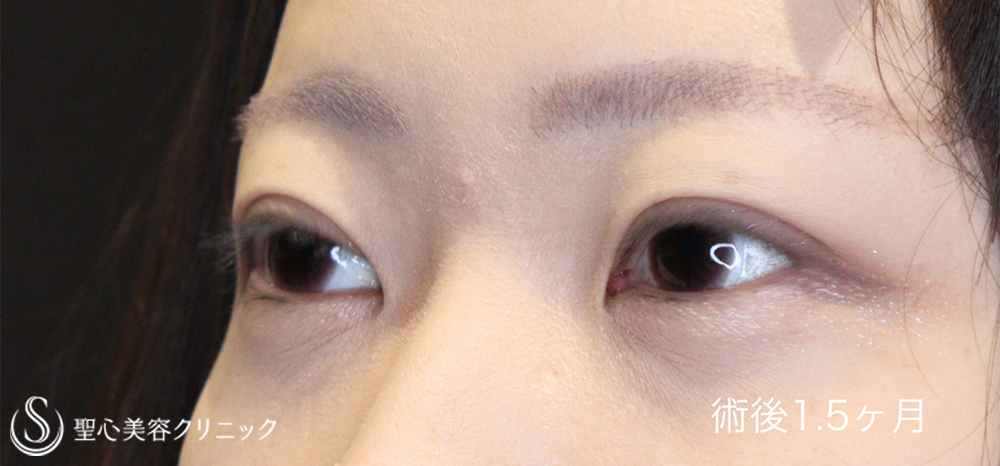 【20代女性・目をぱっちり印象的に】マイクロメソッド+α（二重埋没法）（1.5ヶ月後） After 