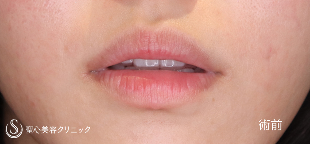 【20代女性・立体感のある唇に】スマイルリップ（2ヶ月後） Before 