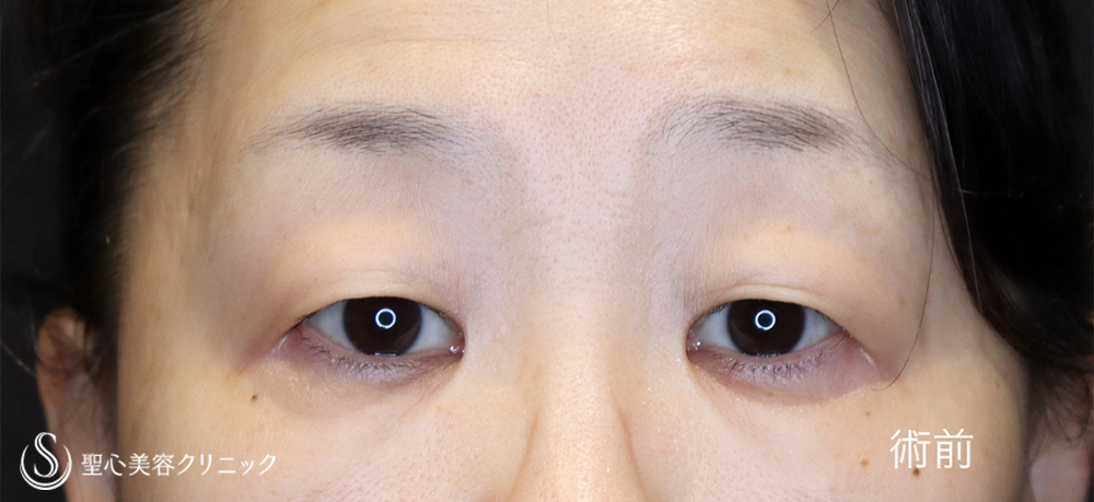 【50代女性・お目元をスッキリと】マイクロメソッド+α（二重埋没法）＋眉下切開法（眉下リフト）（1ヶ月後） Before 