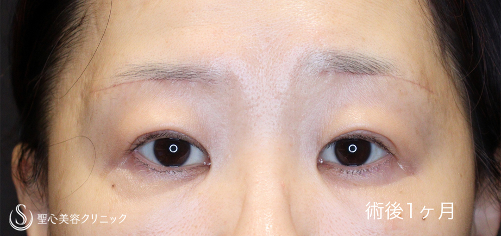 【50代女性・お目元をスッキリと】マイクロメソッド+α（二重埋没法）＋眉下切開法（眉下リフト）（1ヶ月後） After 