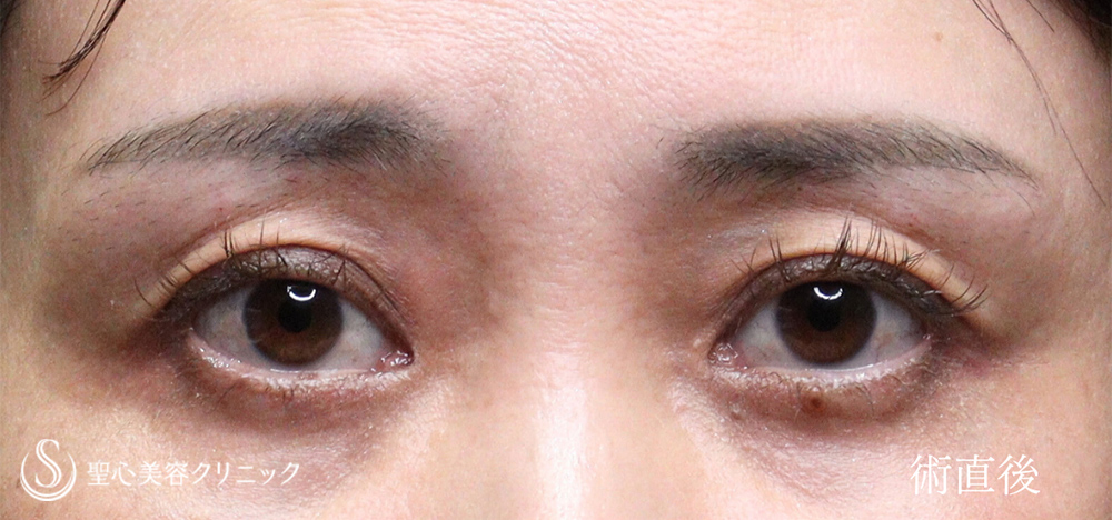 【40代女性・窪み目対策】ヒアルロン酸注入（直後） After 