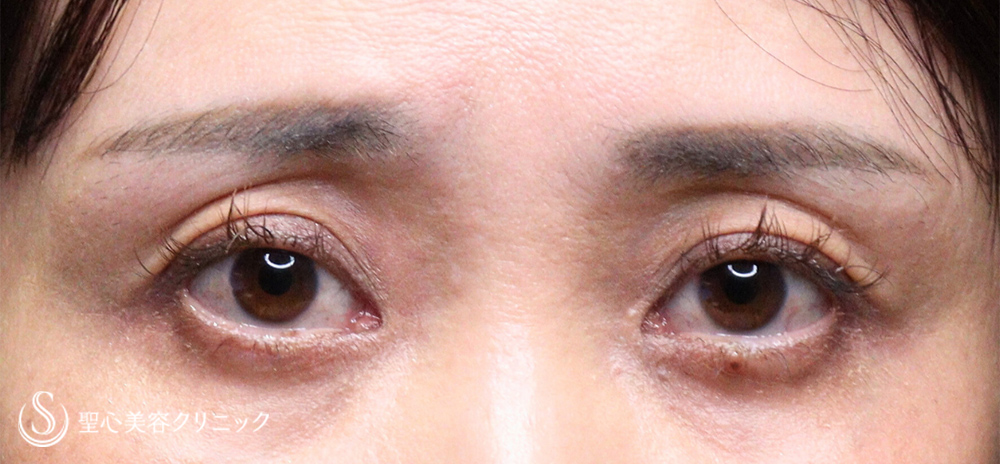 【40代女性・窪み目対策】ヒアルロン酸注入（直後） Before 