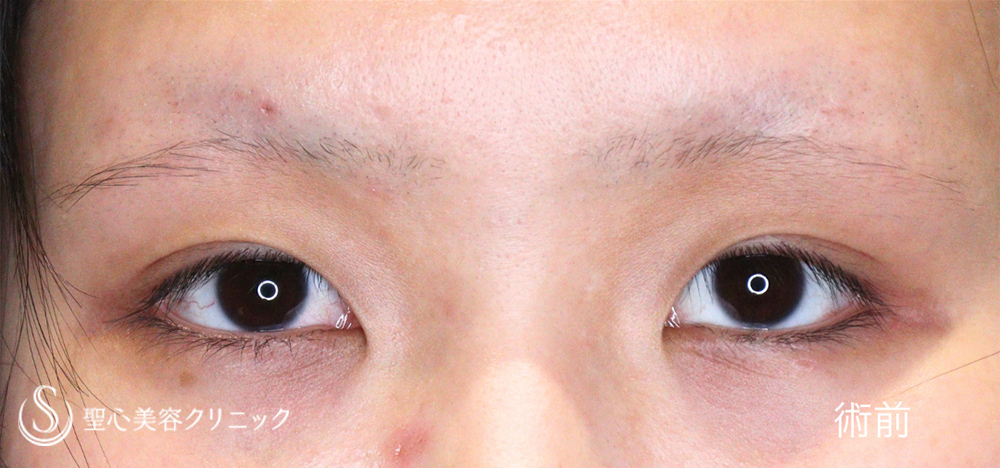 【20代女性・目を寄せずに蒙古襞のハリを解除】目上切開（1.5ヶ月後） Before 