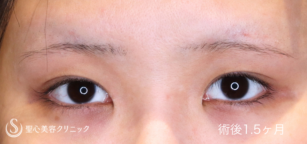 【20代女性・目を寄せずに蒙古襞のハリを解除】目上切開（1.5ヶ月後） After 
