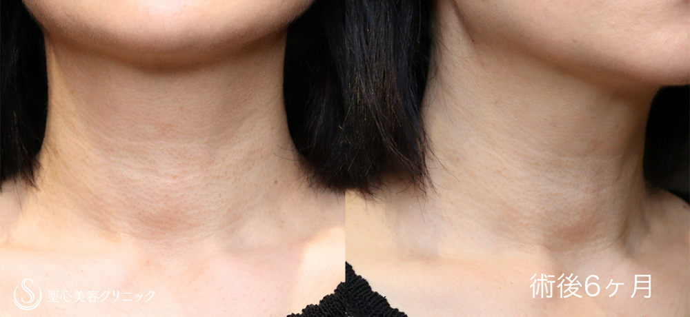 【30代女性・PRPで首の皺を劇的に改善】プレミアムPRP皮膚再生療法（6ヶ月後） After 