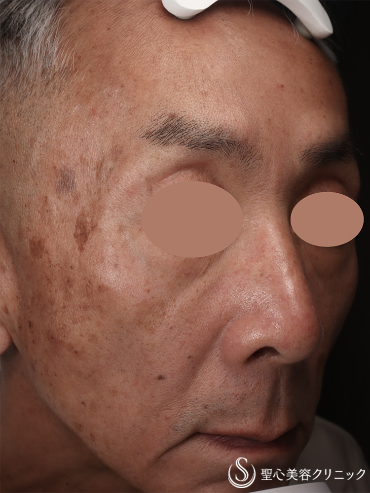 【50代男性・全顔のシミ】PICOレーザー（3ヶ月後） Before 