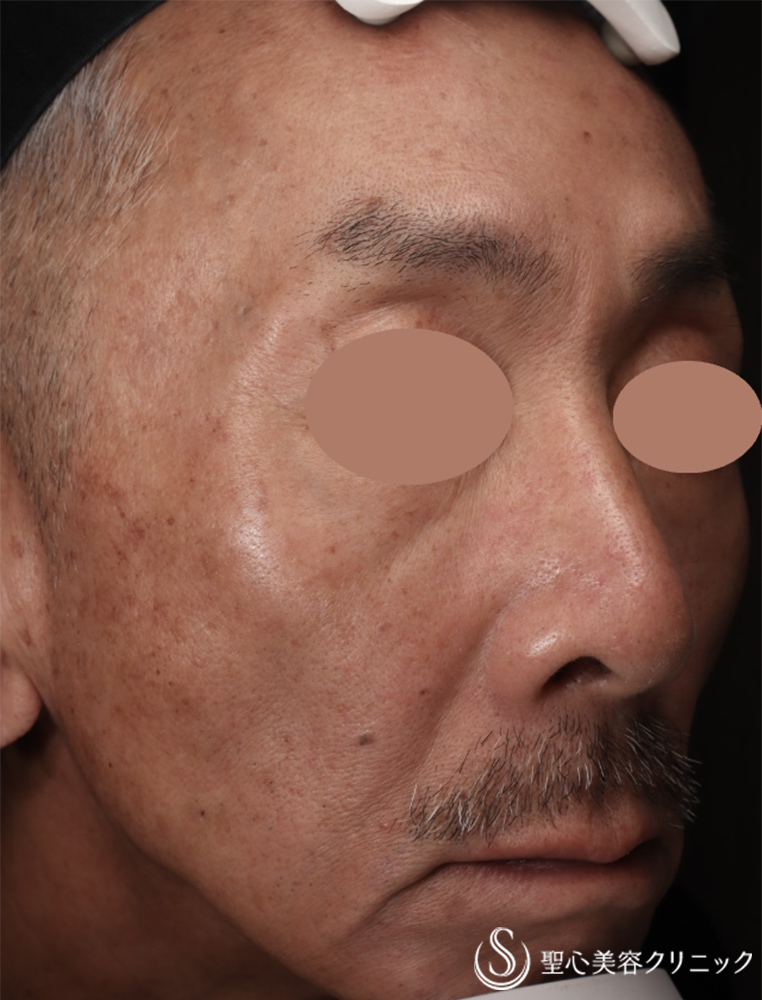 【50代男性・全顔のシミ】PICOレーザー（3ヶ月後） After 