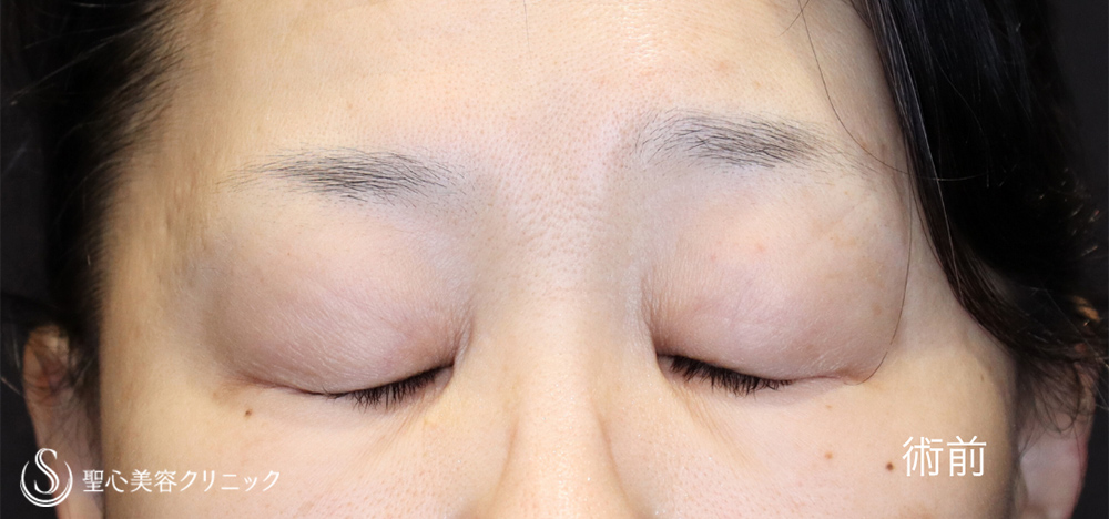 【50代女性・お目元をスッキリと】マイクロメソッド+α（二重埋没法）＋眉下切開法（眉下リフト）（1ヶ月後） Before 