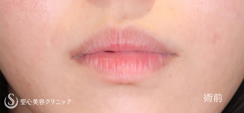 【20代女性・立体感のある唇に】スマイルリップ（2ヶ月後） Before 