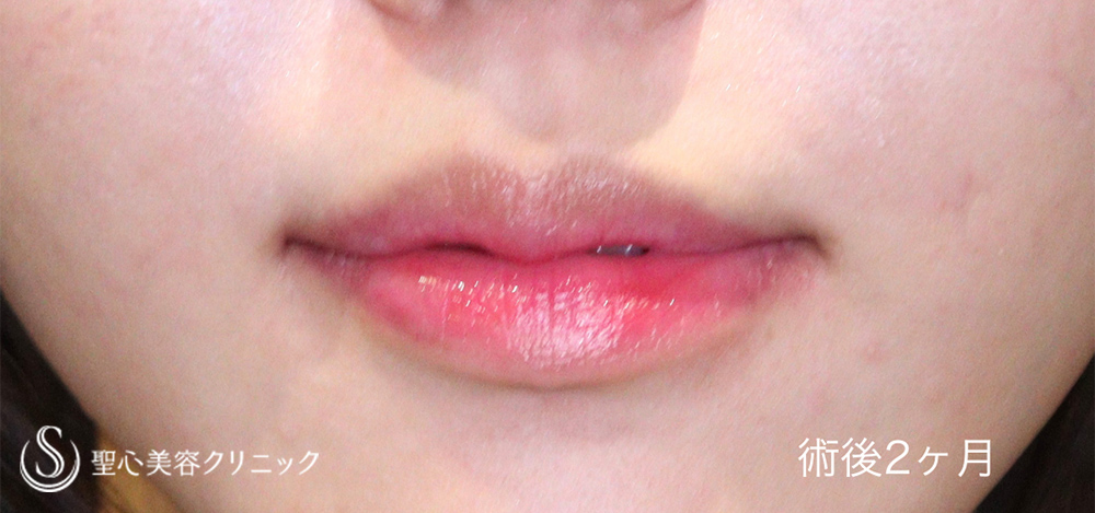 【20代女性・立体感のある唇に】スマイルリップ（2ヶ月後） After 