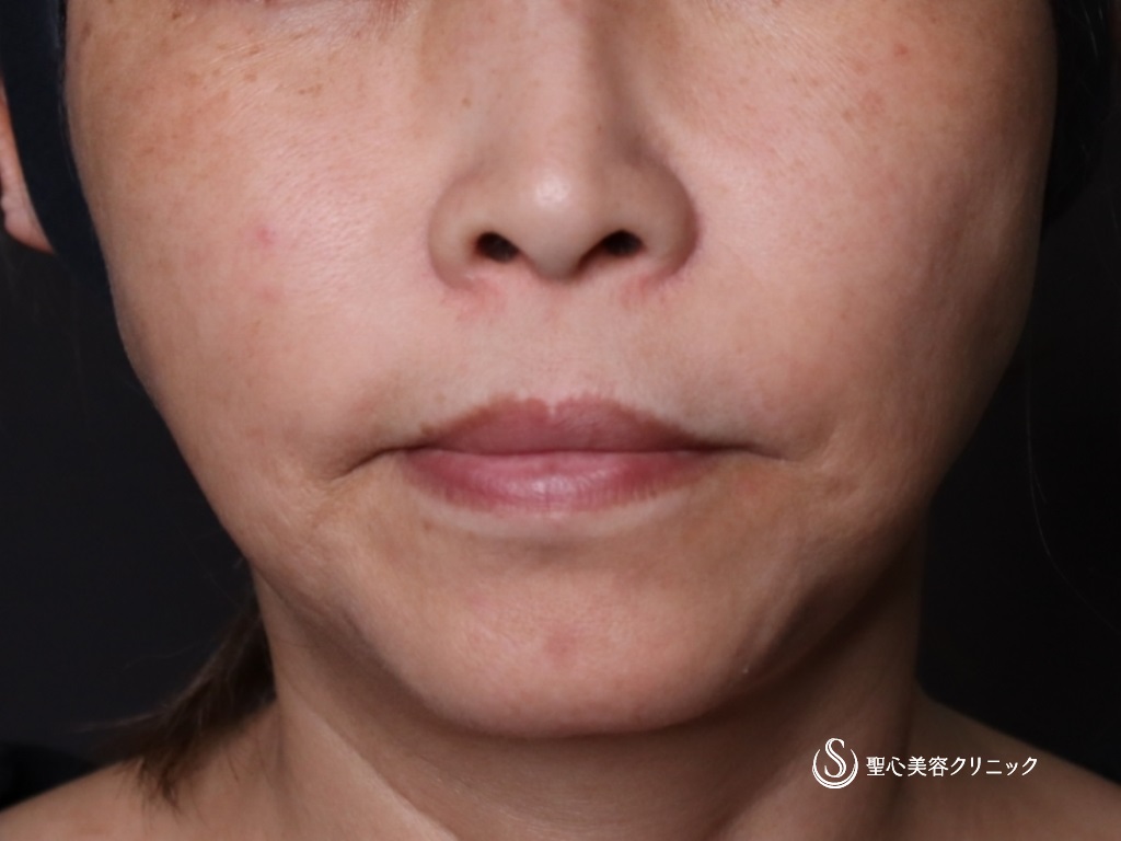 【50代女性・若々しい輪郭に】アンカーMAX（1ヶ月後） Before 