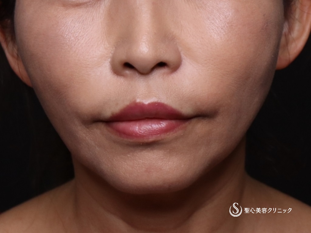 【50代女性・若々しい輪郭に】アンカーMAX（1ヶ月後） After 
