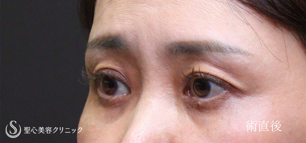 【40代女性・窪み目対策】ヒアルロン酸注入（直後） After 
