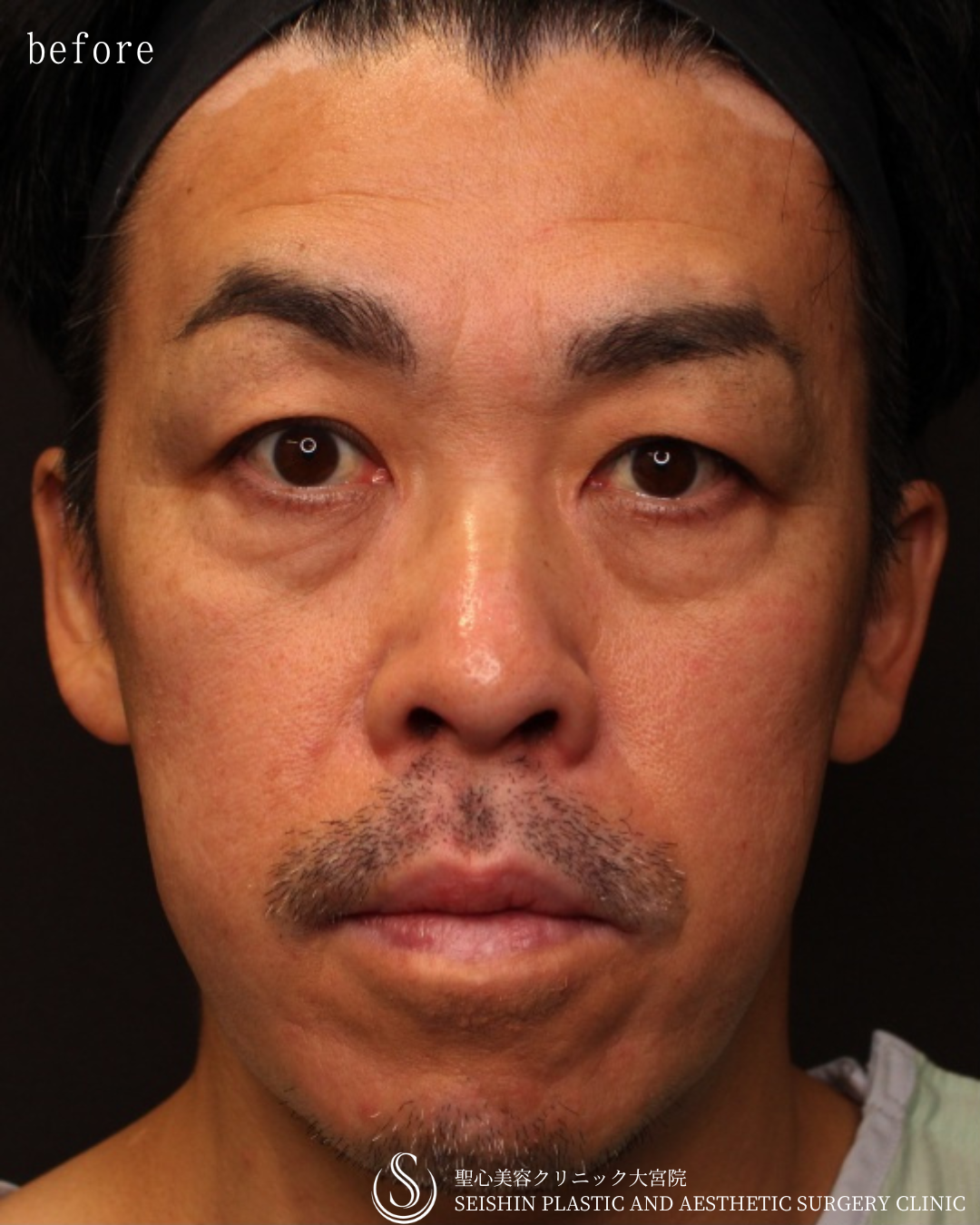 【40代男性・切らずに顔全体の若返り】プレミアムPRP皮膚再生療法（6ヶ月後） Before 