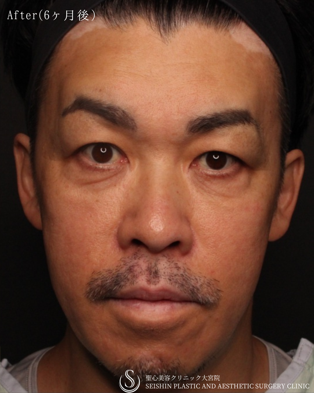 【40代男性・切らずに顔全体の若返り】プレミアムPRP皮膚再生療法（6ヶ月後） After 