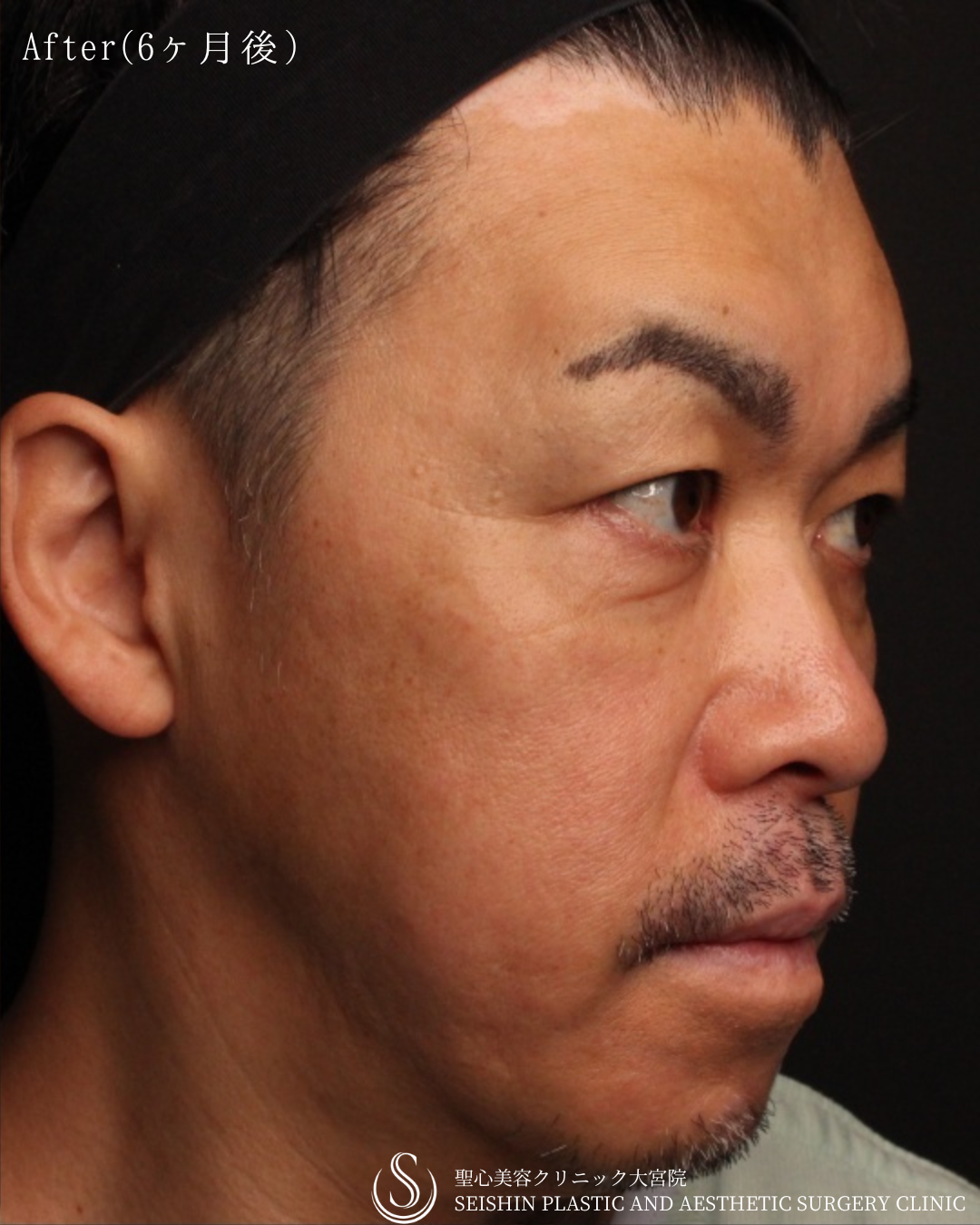 【40代男性・切らずに顔全体の若返り】プレミアムPRP皮膚再生療法（6ヶ月後） After 