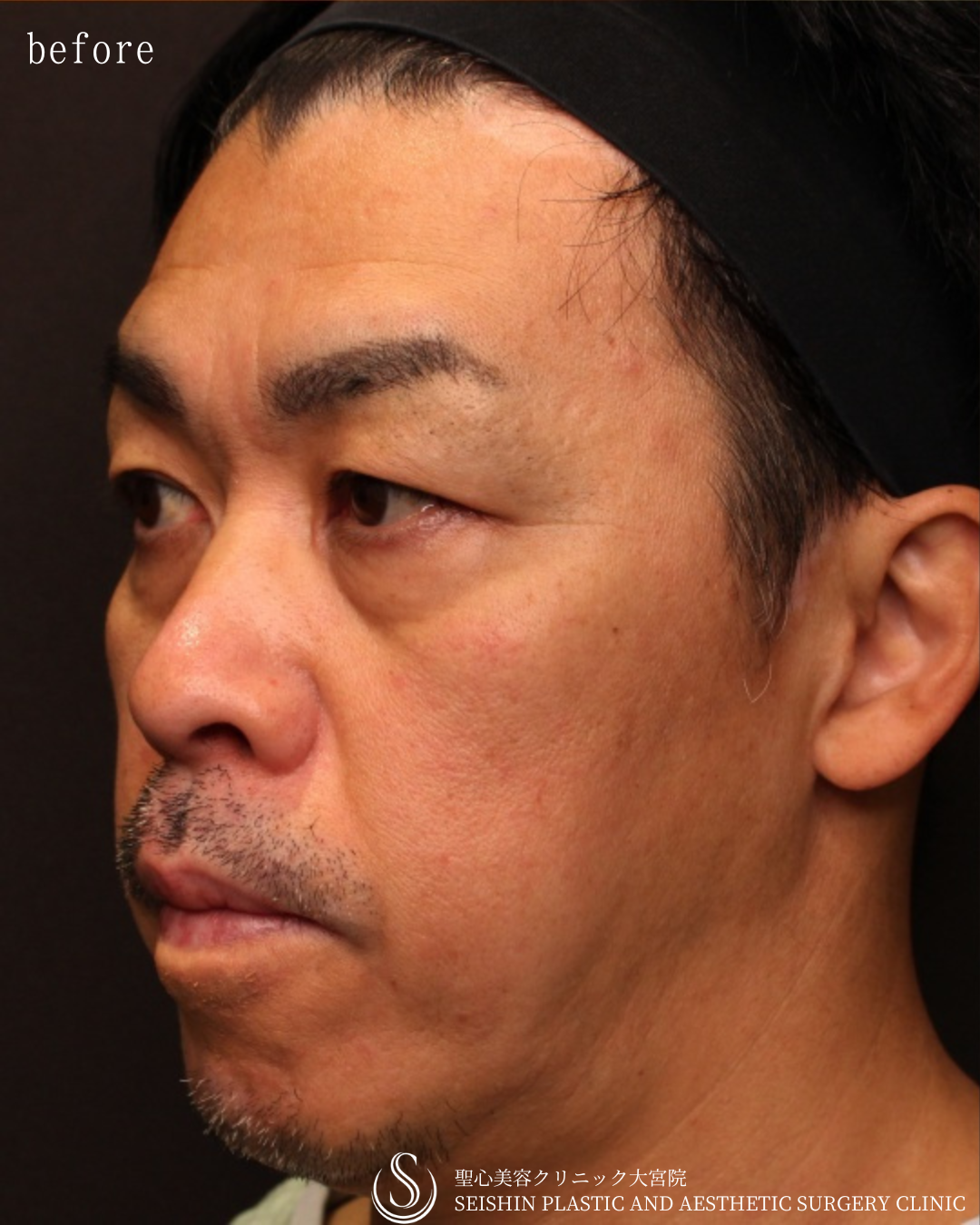 【40代男性・切らずに顔全体の若返り】プレミアムPRP皮膚再生療法（6ヶ月後） Before 