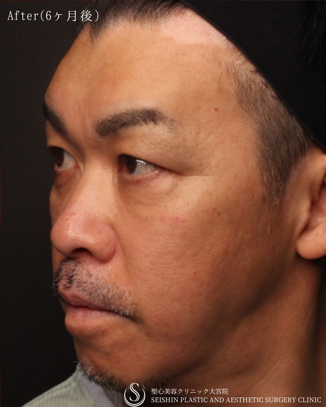 【40代男性・切らずに顔全体の若返り】プレミアムPRP皮膚再生療法（6ヶ月後） After 