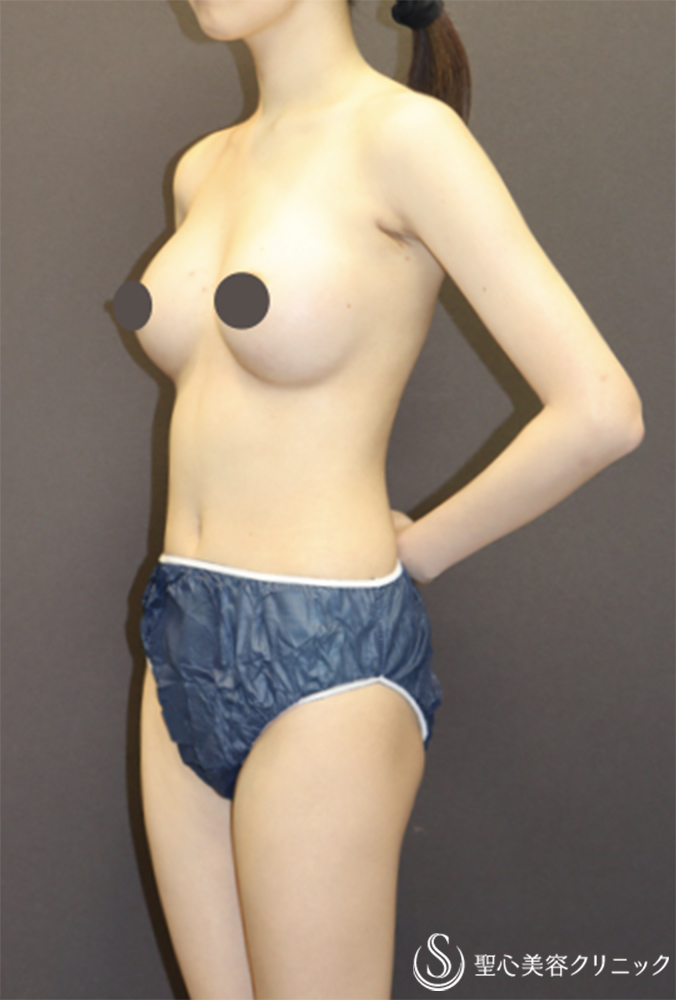 【20代女性・水着でも映えるナチュラル豊胸】バッグプロテーゼ挿入法（モディバエルゴノミクス2/MINI250cc）（3ヶ月後） After 